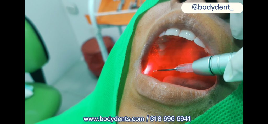 Bichectomia laser /buccal fat